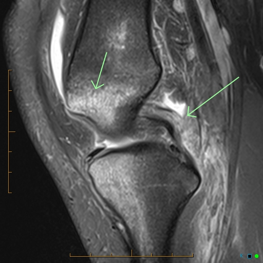 Posterolateral Corner Injury Of The Knee | Image | Radiopaedia.org