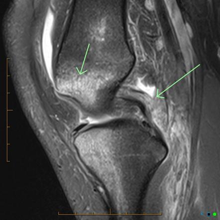 Posterolateral Corner Injury Of The Knee 