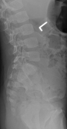 Lumbar spine (AP/PA view) | Radiology Reference Article | Radiopaedia.org