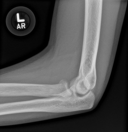 Radial neck fracture | Radiology Case | Radiopaedia.org