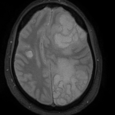 Cerebral cryptococcosis | Image | Radiopaedia.org