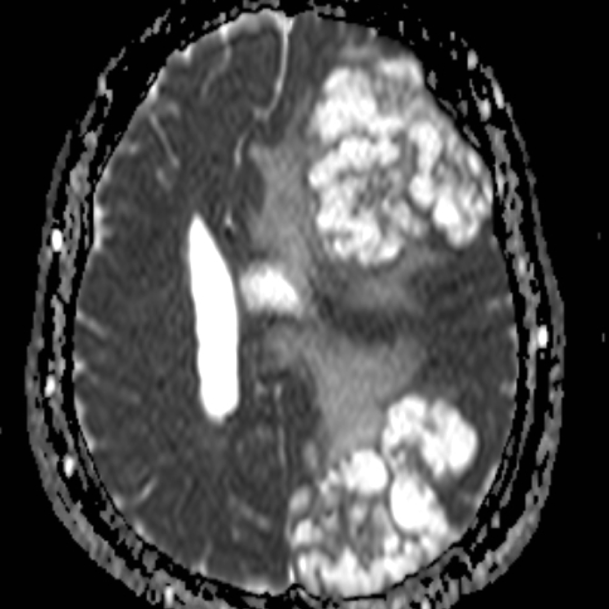 Cerebral Cryptococcosis Image