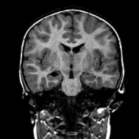 Choroidal Fissure Cyst Radiology Reference Article Radiopaedia Org