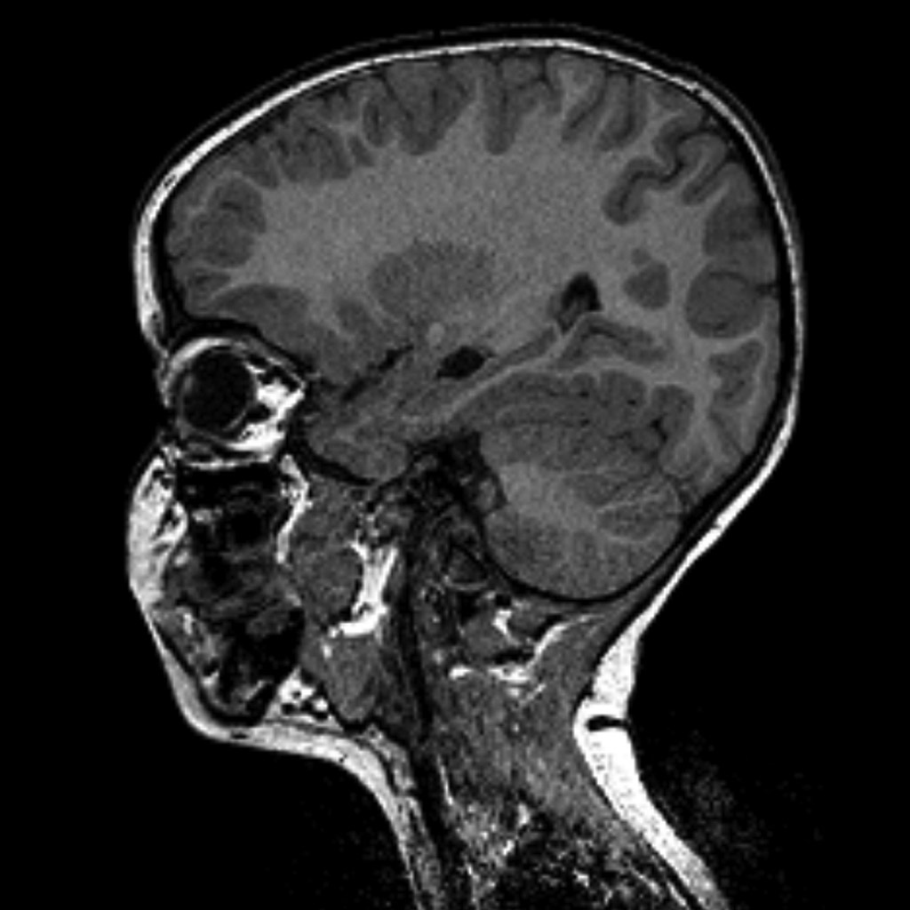 Choroidal fissure cyst | Image | Radiopaedia.org