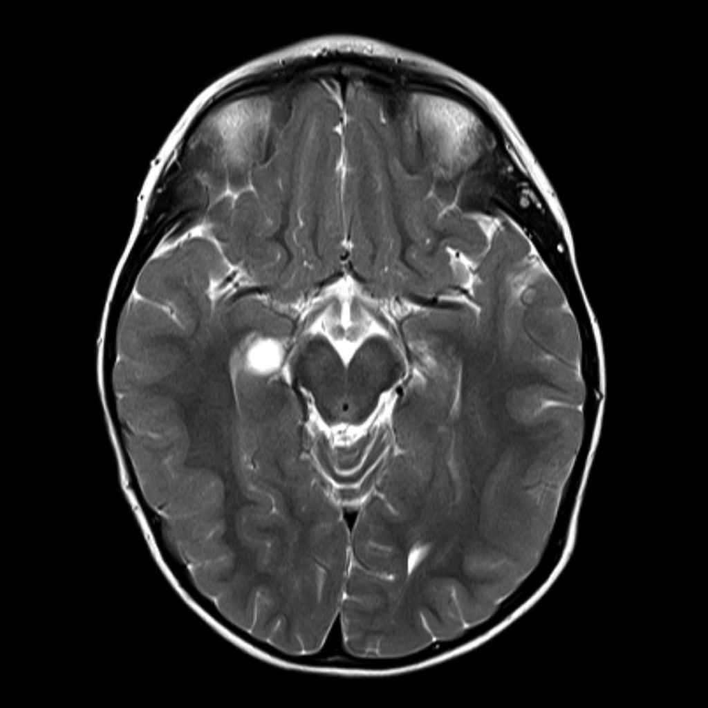 Choroidal Fissure Cyst MRI