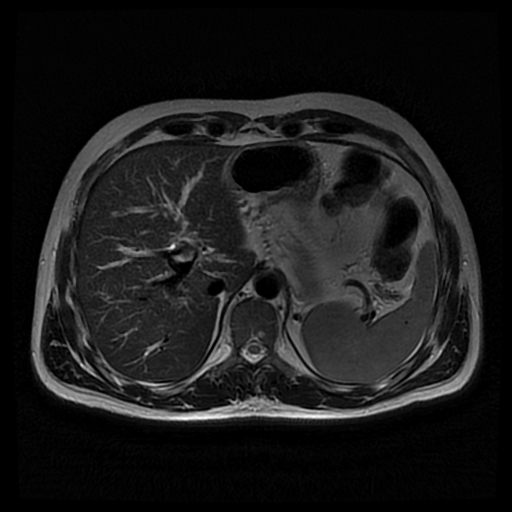 Primary sclerosing cholangitis | Image | Radiopaedia.org