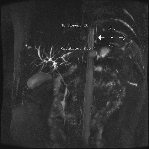 Primary Sclerosing Cholangitis Image 