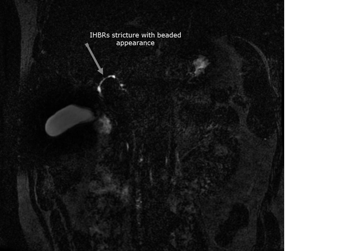 Primary Sclerosing Cholangitis | Image | Radiopaedia.org