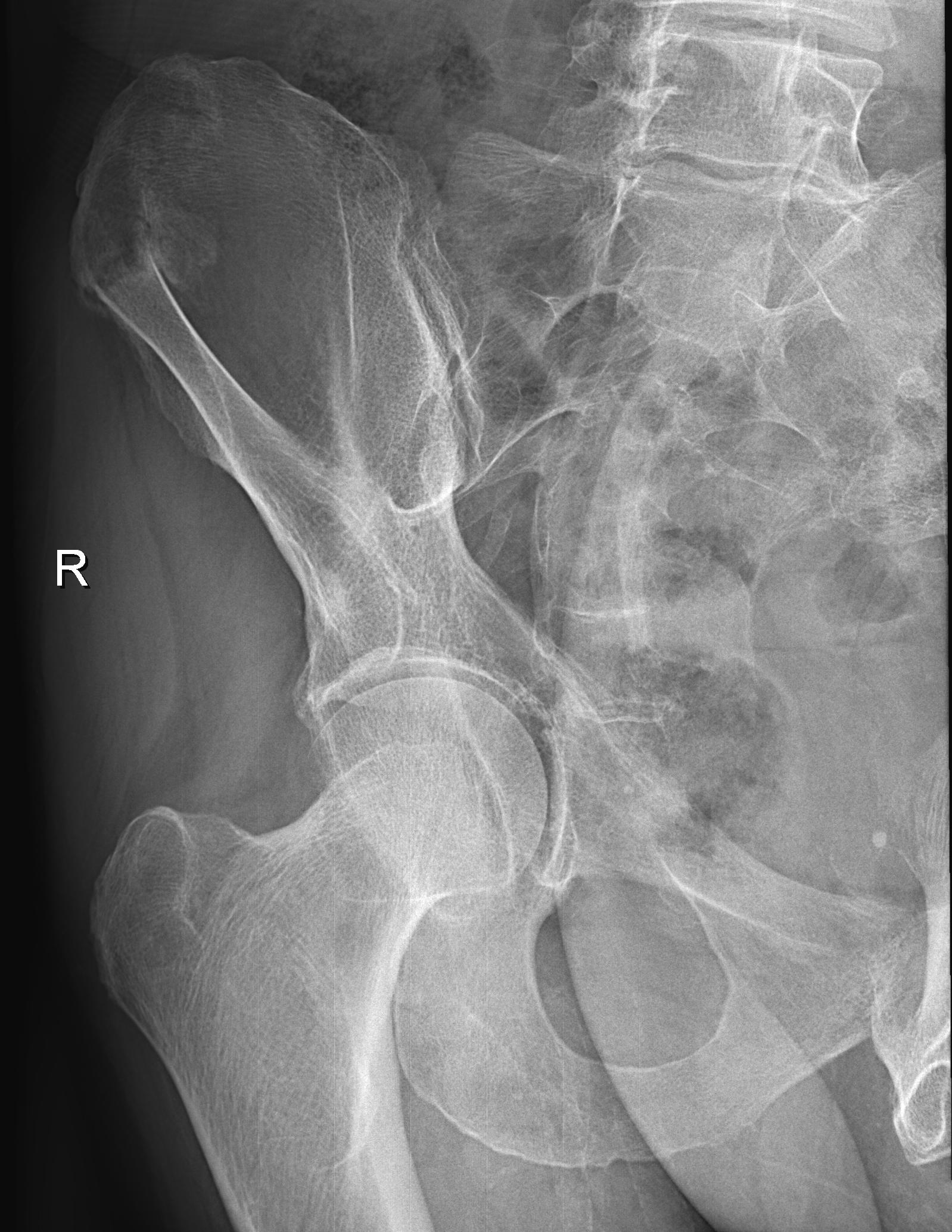 Right iliac wing fracture - Duverney fracture | Image | Radiopaedia.org