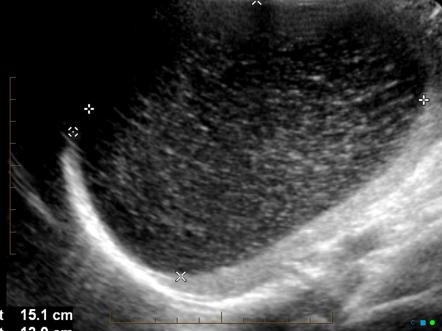 Splenic cyst | Radiology Reference Article | Radiopaedia.org