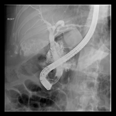 Duodenal perforation post ERCP | Radiology Case | Radiopaedia.org