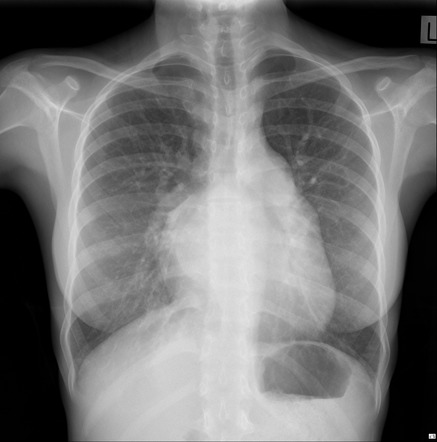 Double density sign (left atrium) | Radiology Reference Article ...