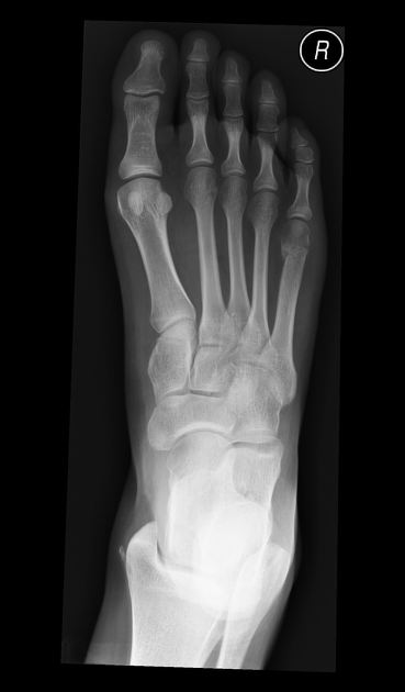 Neck of the 5th metatarsal fracture Radiology Case Radiopaedia