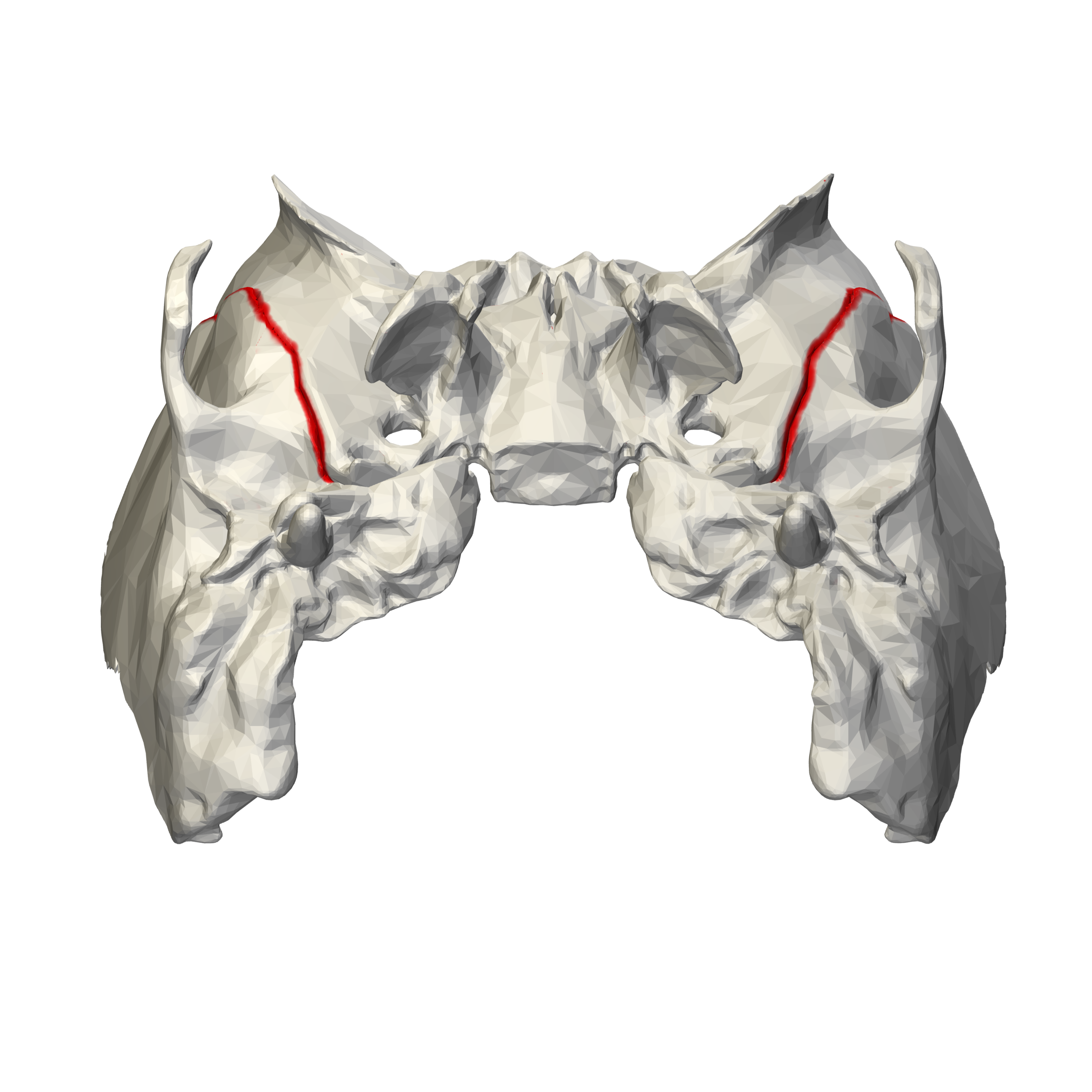 Sphenosquamosal suture (illustrations) | Image | Radiopaedia.org