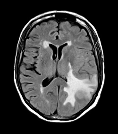 Cerebral metastasis | Image | Radiopaedia.org