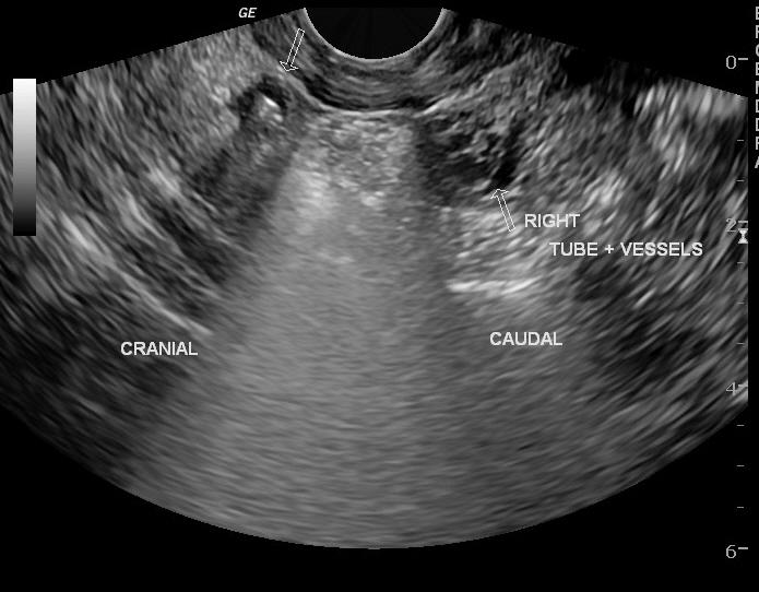 Migration Of Intrauterine Device Image Radiopaedia Org   0e71d363d380105d6e8110ede0f8b8 