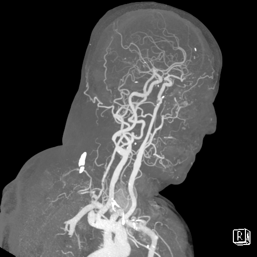 Left Cerebellar Infarct PICA Vascular Territory Image Radiopaedia Org