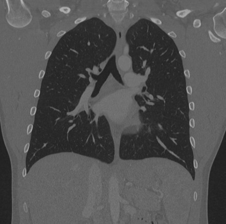 Normal CTA chest | Image | Radiopaedia.org