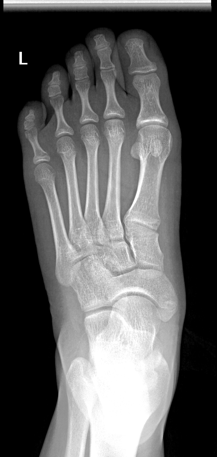 Fracture of the base of the proximal phalanx of the little toe xray