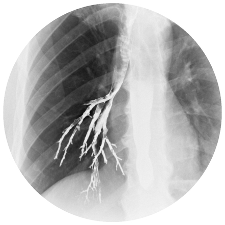 Barium Aspiration | Radiology Reference Article | Radiopaedia.org