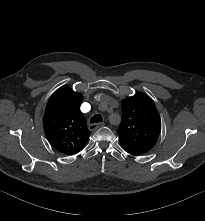 Pectoralis major lipoma | Radiology Case | Radiopaedia.org