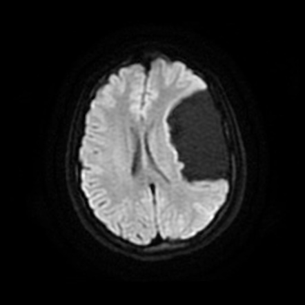 Arachnoid cyst | Image | Radiopaedia.org