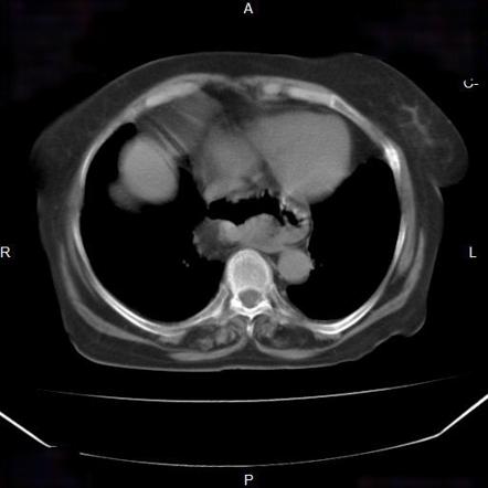 Paraesophageal hernia | Radiology Reference Article | Radiopaedia.org