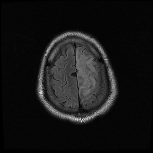 Anterior cerebral artery infarction | Image | Radiopaedia.org