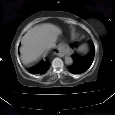 Hiatus hernia | Radiology Reference Article | Radiopaedia.org