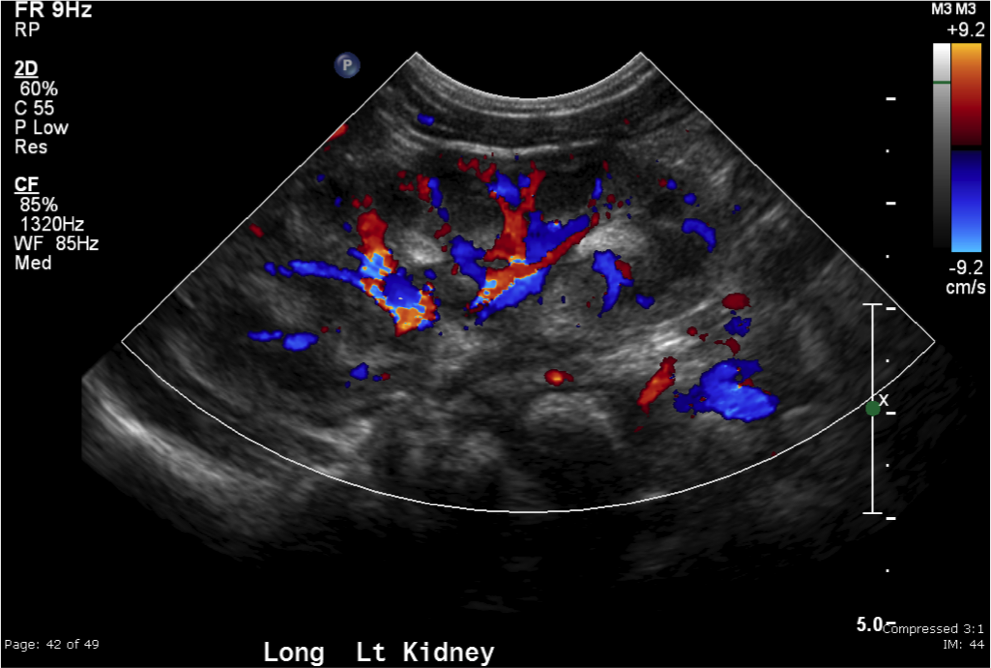 Echogenic medullary pyramids | Image | Radiopaedia.org