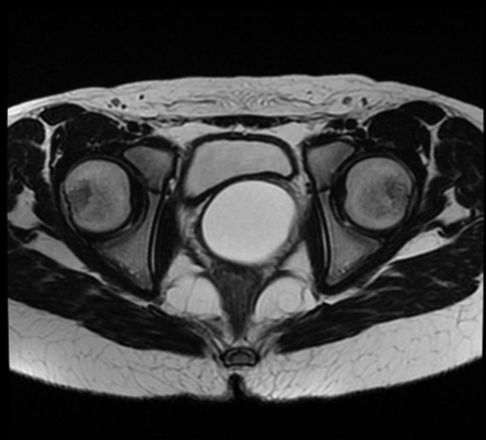 Herlyn-Werner-Wunderlich Syndrome | Radiology Case | Radiopaedia.org