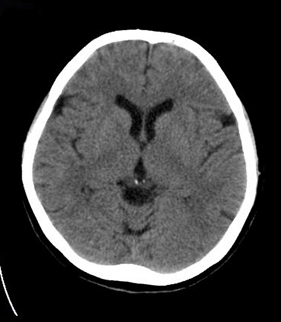 cavum velum interpositum ultrasound