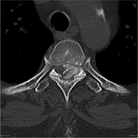 Spinal meningioma - densely calcified | Radiology Case | Radiopaedia.org