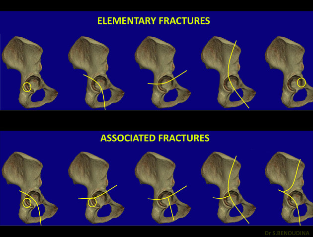 Radiology And Classification Of Acetabular Fractures-, 45% OFF