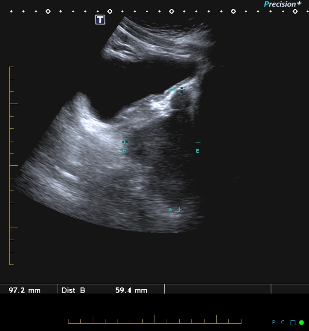 Cowper gland cyst Image