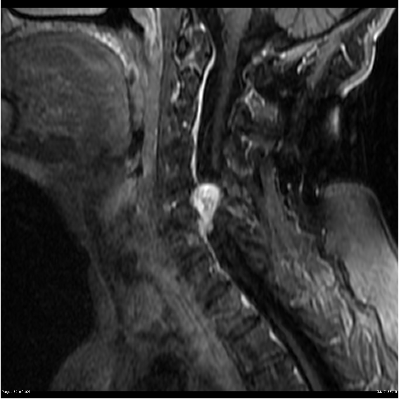 Spinal schwannoma (cervical) | Image | Radiopaedia.org