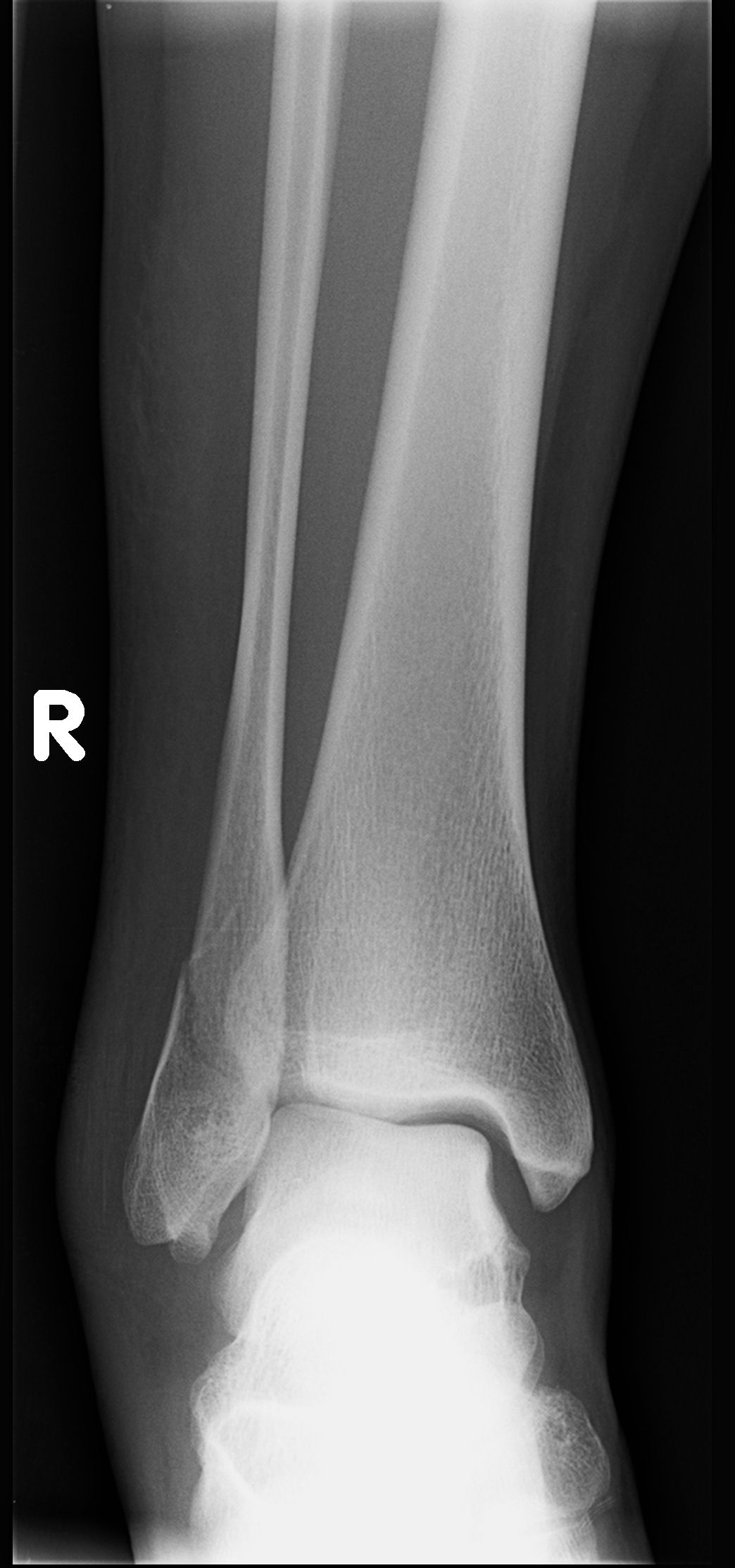 Ankle Fracture - Weber B | Image | Radiopaedia.org