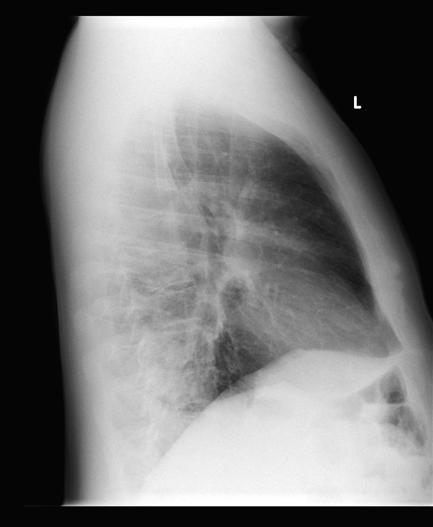 Left Lower Lobe Pneumonia Image