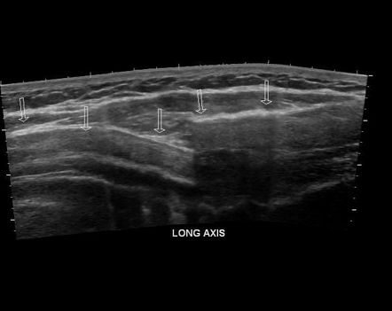 Costal cartilage fracture | Radiology Case | Radiopaedia.org