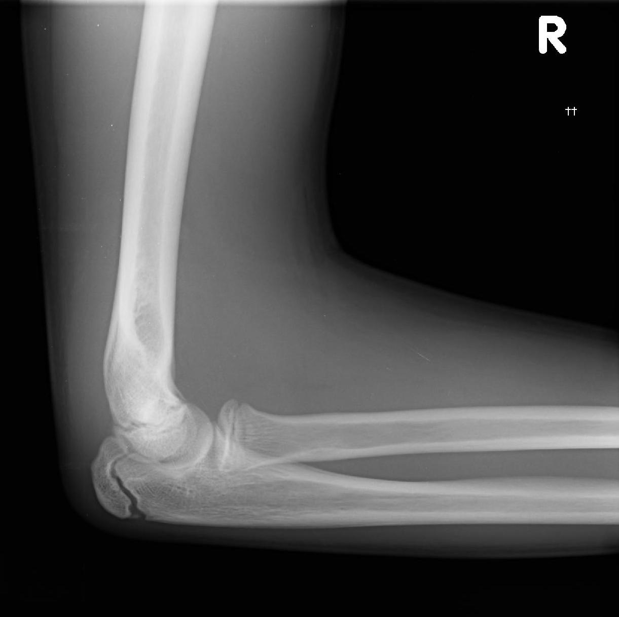 Medial Epicondyle Fracture Image Radiopaedia Org