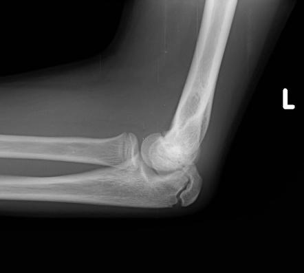 Medial epicondyle fracture | Image | Radiopaedia.org