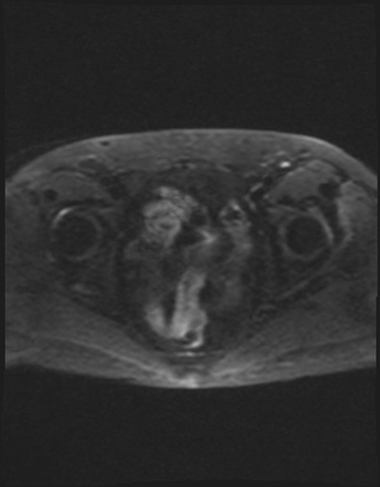 Small bowel edema after rectal cancer radiotherapy | Image ...