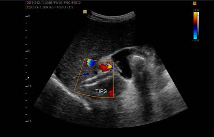 Transjugular Intrahepatic Portosystemic Shunt (TIPS) Occlusion | Image ...