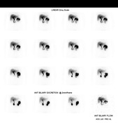 Cholescintigraphy Radiology Reference Article Radiopaedia Org