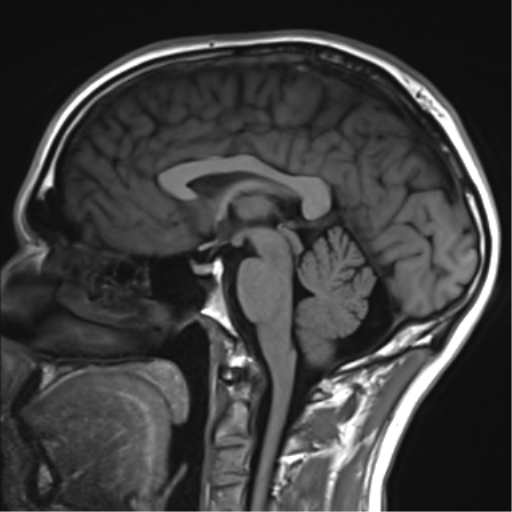 Chondrosarcoma (clivus) | Image | Radiopaedia.org