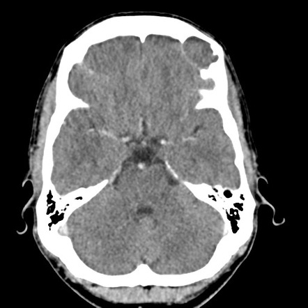 Angular epidermoid cyst | Image | Radiopaedia.org