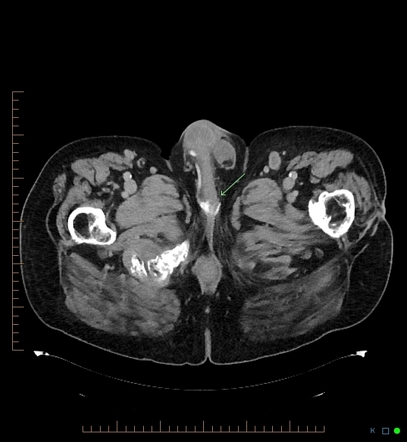 Artificial urethral sphincters | Radiology Reference Article ...