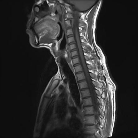 Acute transverse myelitis | Image | Radiopaedia.org