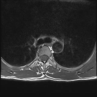 Acute transverse myelitis | Image | Radiopaedia.org