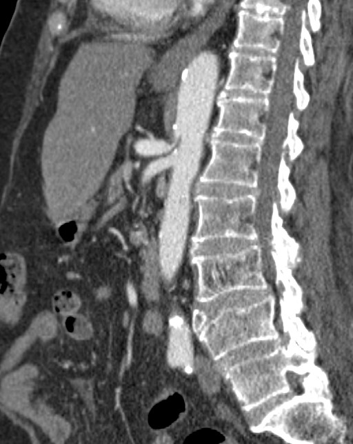 Median arcuate ligament syndrome | Image | Radiopaedia.org